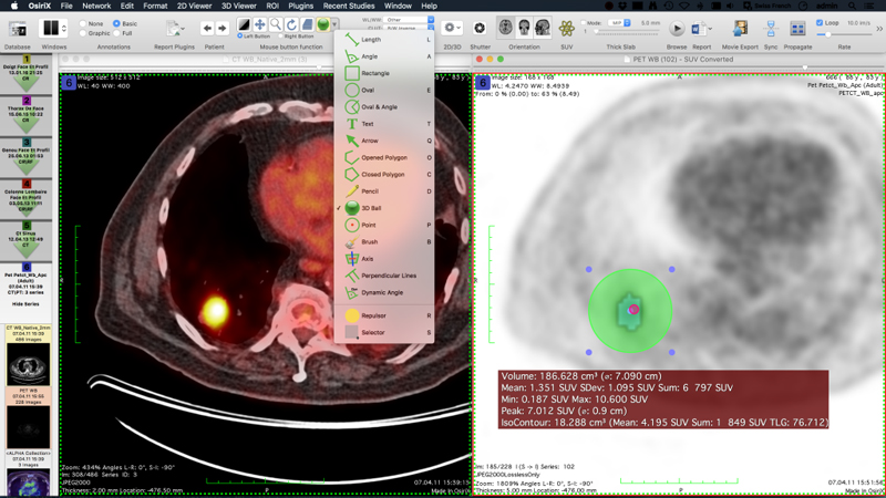OsiriX | MacOS X対応 医用画像 解析 ソフトウェア